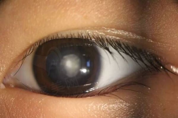 儿童先天性白内障能治好吗？小孩白内障手术大概要多少钱？
