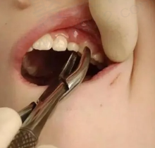 拔牙十天了感觉拔牙窝有点胀怎么办？来看拔牙10天后牙窝状态图