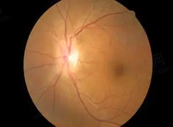 视神经炎是什么症状，想知道视神经炎能治好吗怎么治疗？