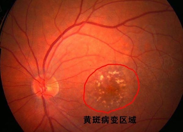 眼底黄斑病变的早期症状，黄斑病变怎么治疗比较好手术大概多少钱？