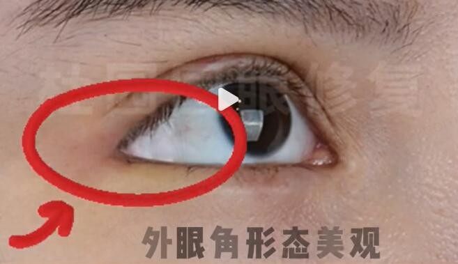 上海杜园园在哪家医院坐诊？怎么样找杜园园面诊修复双眼皮呢