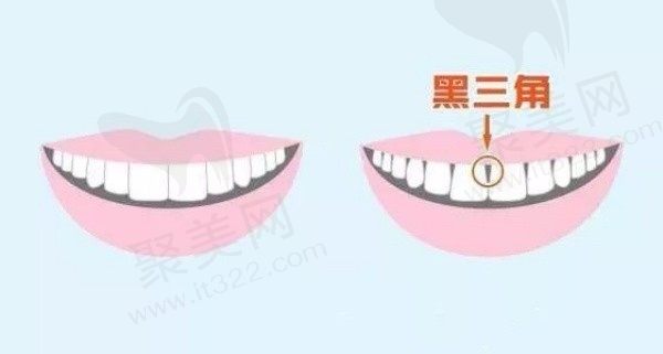 牙齿矫正出现黑三角还可以恢复吗？如何避免出现黑三角？