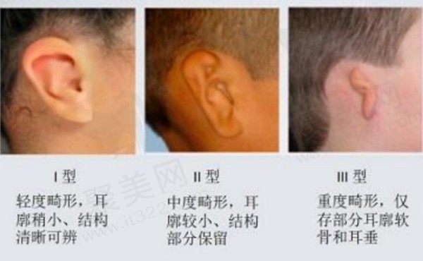 小耳畸形一度二度三度图片对比，小耳畸形是什么原因造成的？