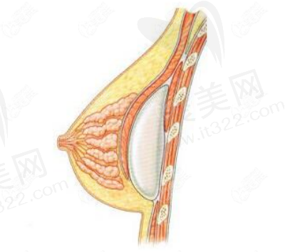 乳房下皱襞切口疤痕明显吗？乳房下皱襞切口是选圆形假体还是水滴形？
