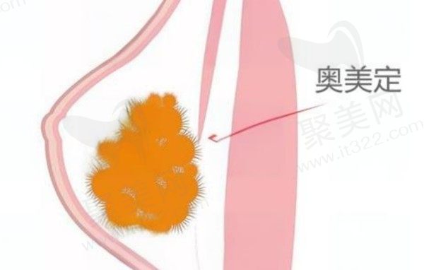 胸部奥美定取出的方式有哪些？奥美定取出术后是否需要修复？