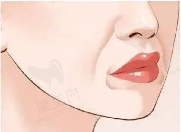 口角囊袋下面部松弛下垂咋办？口角囊袋吸脂好还是溶脂好？