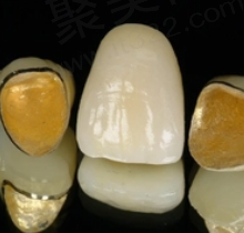 金属烤瓷牙能做核磁共振吗？金属烤瓷牙分为几种，哪种好？