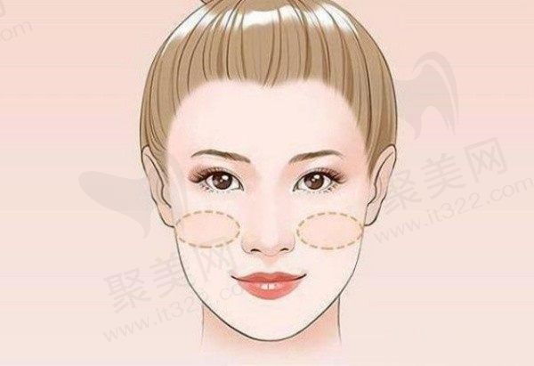 苹果肌下垂提升的较好方法是什么？苹果肌饱满好还是不好？