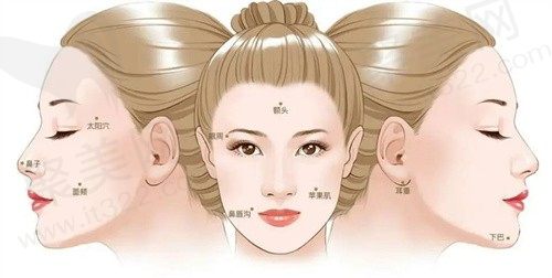 上海美莱侯怡医生怎么样?面部溶脂精雕二合一不开刀塑造立体V脸