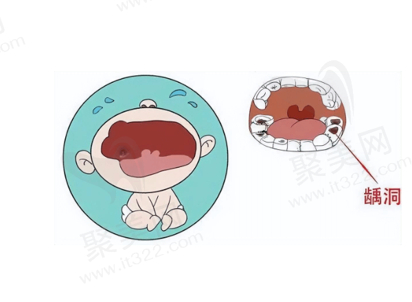 儿童牙齿钙化是缺钙引起的吗？怎么治疗疗效好呢？好的预防方法有哪些？