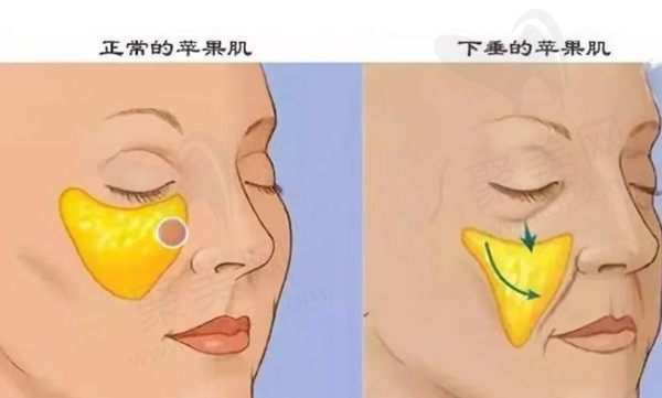 苹果肌下垂了还能提上吗？苹果肌太大了应该怎么改善？