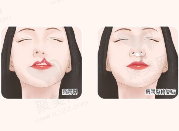 武汉同济叶子荣唇腭裂鼻修复价格29800起，高难度修复案例口碑好
