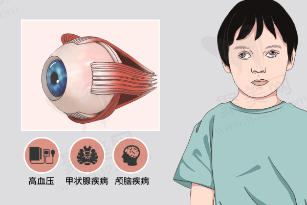 麻痹性斜视是怎么造成的？优选考虑的治疗方法有哪些？治疗费用高吗？