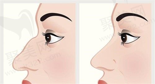 南京美莱做鼻子怎么样?郭心怡轻盈灵动鼻折叠度高立体性好口碑不错！