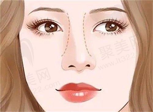 泉州薇琳凯做鼻子怎么样? 李强医生薇琳凯6D美鼻全方位测量更立体口碑超好
