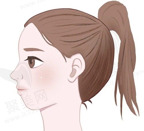 垫下巴可以改善凸嘴吗？求问垫下巴用硅胶好还是膨体好？