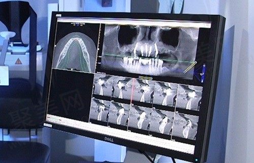 重庆团圆口腔医院种植牙价格真的便宜吗？种植牙2680元起确实便宜