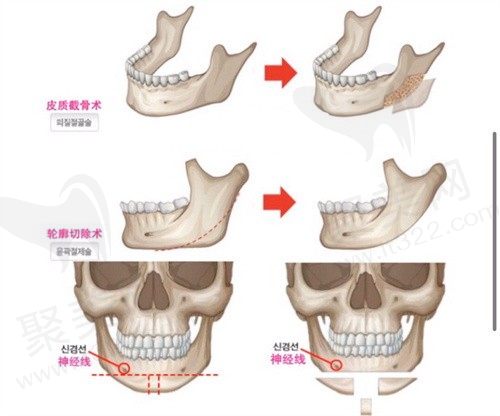 上海时光何晋龙医生3D下颌角成形术58000元起，采用PEEK材料无损伤排异触摸无轮廓感