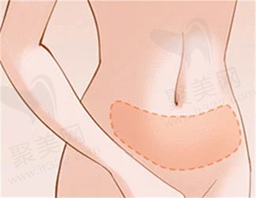 北京艺美医疗美容医院怎么样?正规脂肪专科整形医院吸脂损伤小技术好口碑不错