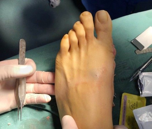 李昕宇医生拇外翻手术好吗？还有李昕宇医生拇外翻手术怎么预约看这里！