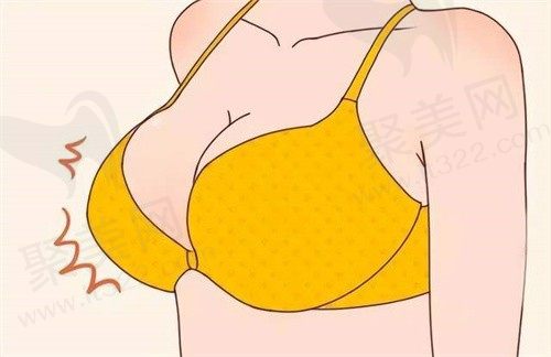 上海华美丰胸好不好?李健特贝茨隆乳术损伤小手感好价格不贵