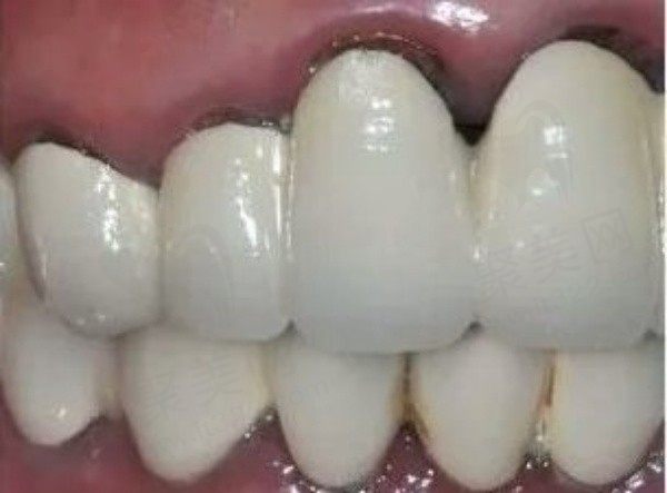 做完烤瓷牙牙龈发黑怎么办?烤瓷牙牙龈发黑还能恢复吗?