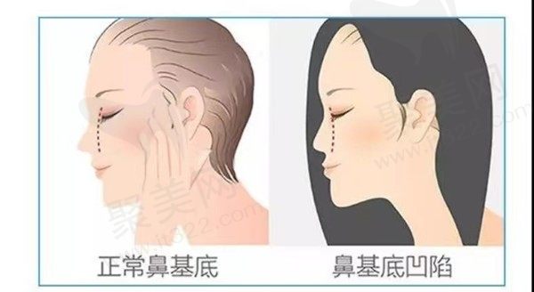 adm填充鼻基底会移位吗？有没有风险？ADM鼻基底一般垫几层