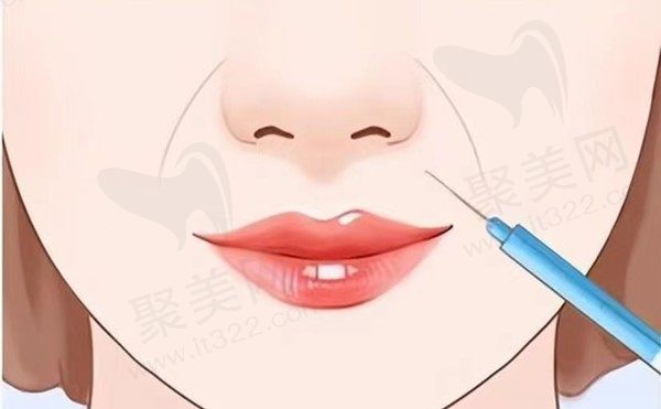 爱拉丝提玻尿酸适合打哪里？爱拉丝提和公主玻尿酸哪个好？