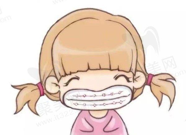 青少年矫正牙齿用哪种牙套好？矫正时间、费用、利弊等汇总