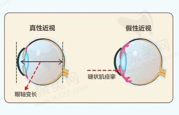 假性近视和真性近视的区别是什么？如果是假性近视怎样治疗能恢复正常？