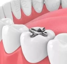 磨牙根管治疗后嵌体修复还是牙套修复？牙齿根管后做嵌体能用几年?