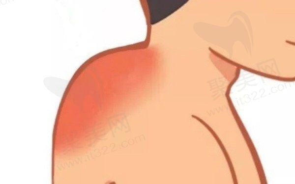 土麦森去除富贵包可靠吗？土麦森吸脂富贵包价格是多少？