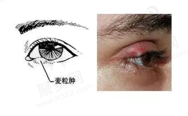 霰粒肿和麦粒肿一样吗？不一样,来看看两者的诸多区别就知道了