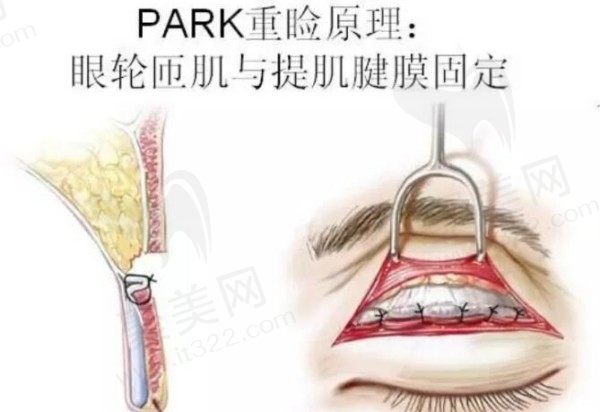 成都素美杨迪做双眼皮怎么样？做帕克10°双眼皮7000元起打造流畅重睑线条