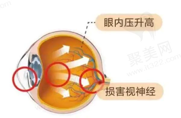 眼压高有什么症状和危害？请问眼压多少为正常范围？