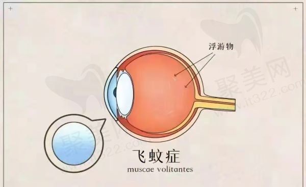 一只眼睛有飞蚊症怎么办？这种情况一般多久会消失呢？