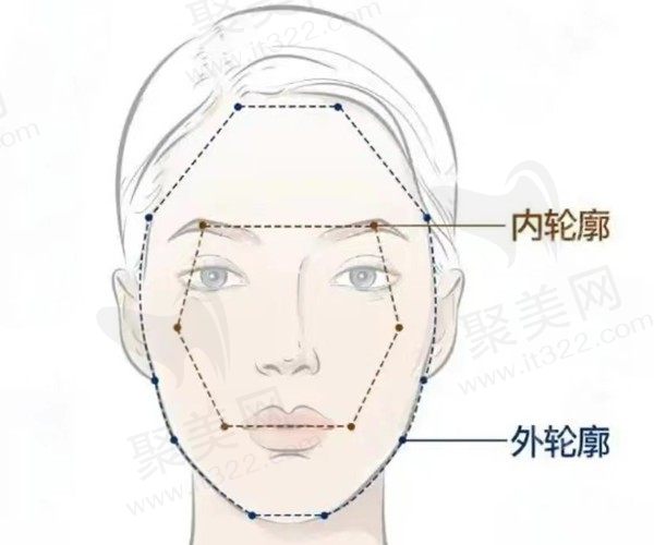 轮廓固定是打玻尿酸吗？想知道轮廓针打几次才能定型？