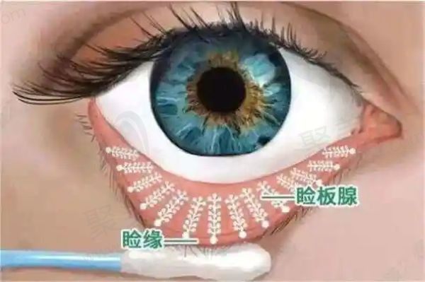 睑板腺萎缩怎么治疗效果好？治好了睑板腺萎缩干眼症能好吗？