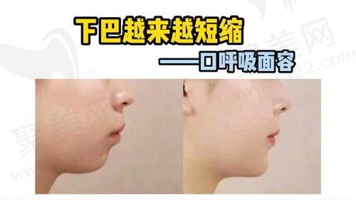 口呼吸的嘴凸后期可以矫正吗？矫正方式大分享