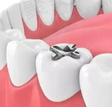 补牙做嵌体好还是直接补好？牙齿嵌体和补牙区别在哪里？