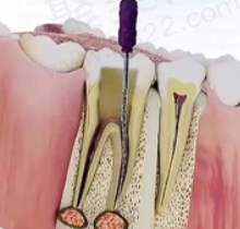 后磨牙根管治疗费用多少钱？后磨牙根管治疗不带牙冠能用多久？