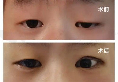 小眼裂综合症是什么？小眼裂综合症会遗传吗
