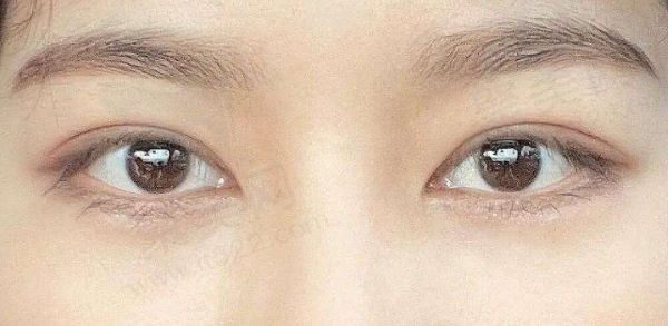武汉星爱医美眼修复怎么样？荣新华医生技术超好做眼修复12800