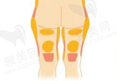 哈尔滨羽禅黄金微雕大腿吸脂价格5570元起，减脂塑形一步到位
