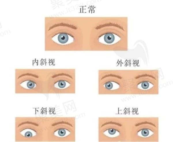南昌华厦眼科医院治疗斜视怎么样？效果挺好的可选鄢涛医生价格5k起