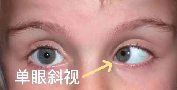 一只眼斜视可以矫正吗？还有一只眼斜视矫正费用大约多少钱？