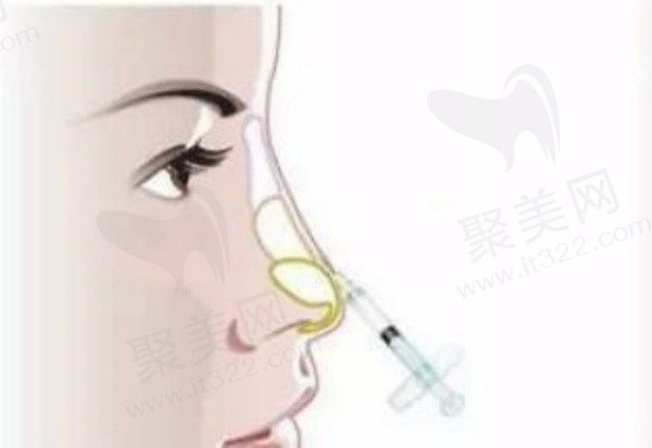 有谁打过骨雕隆鼻吗？液态骨雕鼻做完后有副作用吗？和玻尿酸的区别是？