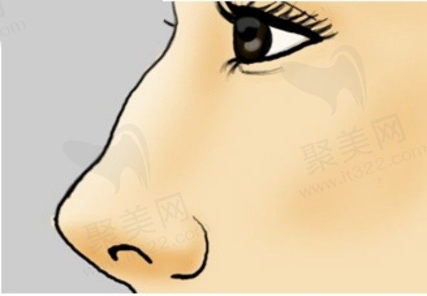 深圳南华西晶张辉做鼻子5.5w元起，隆鼻技术靠谱没有失败案例