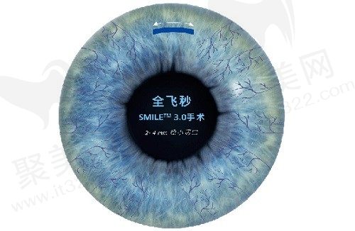 宁波爱尔眼科全飞秒价格1.7w起，收费合理可安全摘镜重获清晰视界