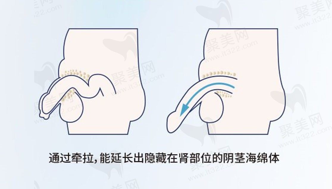 揭秘李世荣延长手术“天价”内幕：6.8w-12.8w贵在哪？独创原理(耻骨预估)与33年经验值不值？利弊全解析